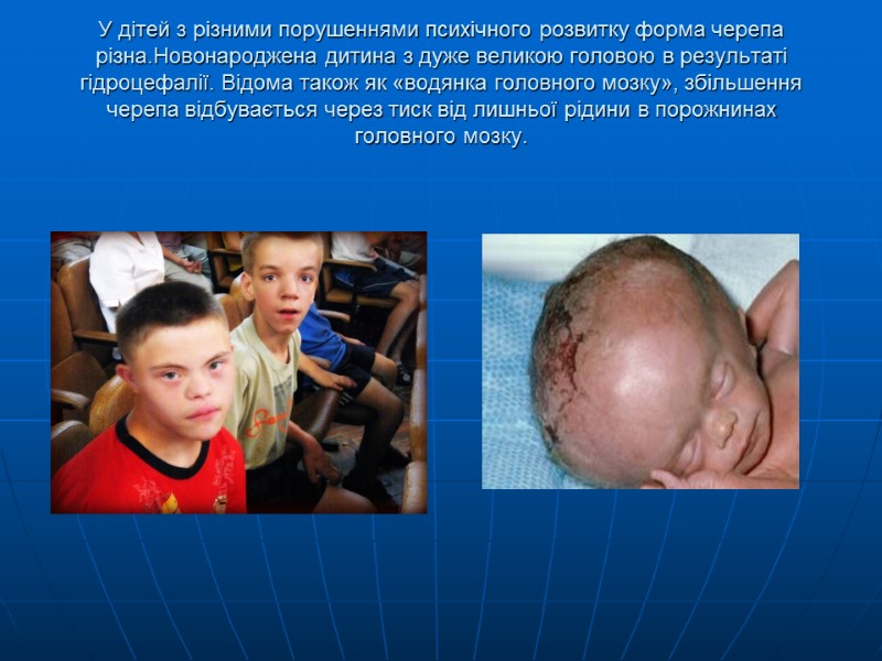 У дітей з різними порушеннями психічного розвитку форма черепа різна.Новонароджена дитина з дуже великою